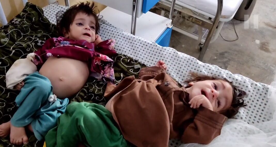 یونېسف: درې میلیونه افغان ماشومان له شدیدې خوارځواکۍ سره مخ دي