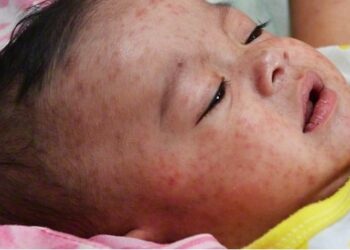 عامې روغتیا وزارت: هېواد کې د شري ناروغۍ  پېښې د تېر کال پرتله زیاتې شوې